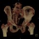 Fracture of pelvis, iliac wing, VRT: CT - Computed tomography